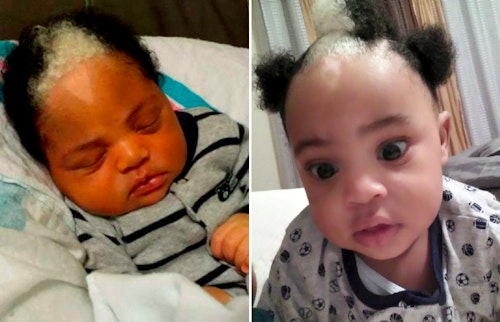 Josiah Barnes white streak birthmark
