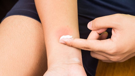Soothe insect bites naturally Soothe insect bites naturally