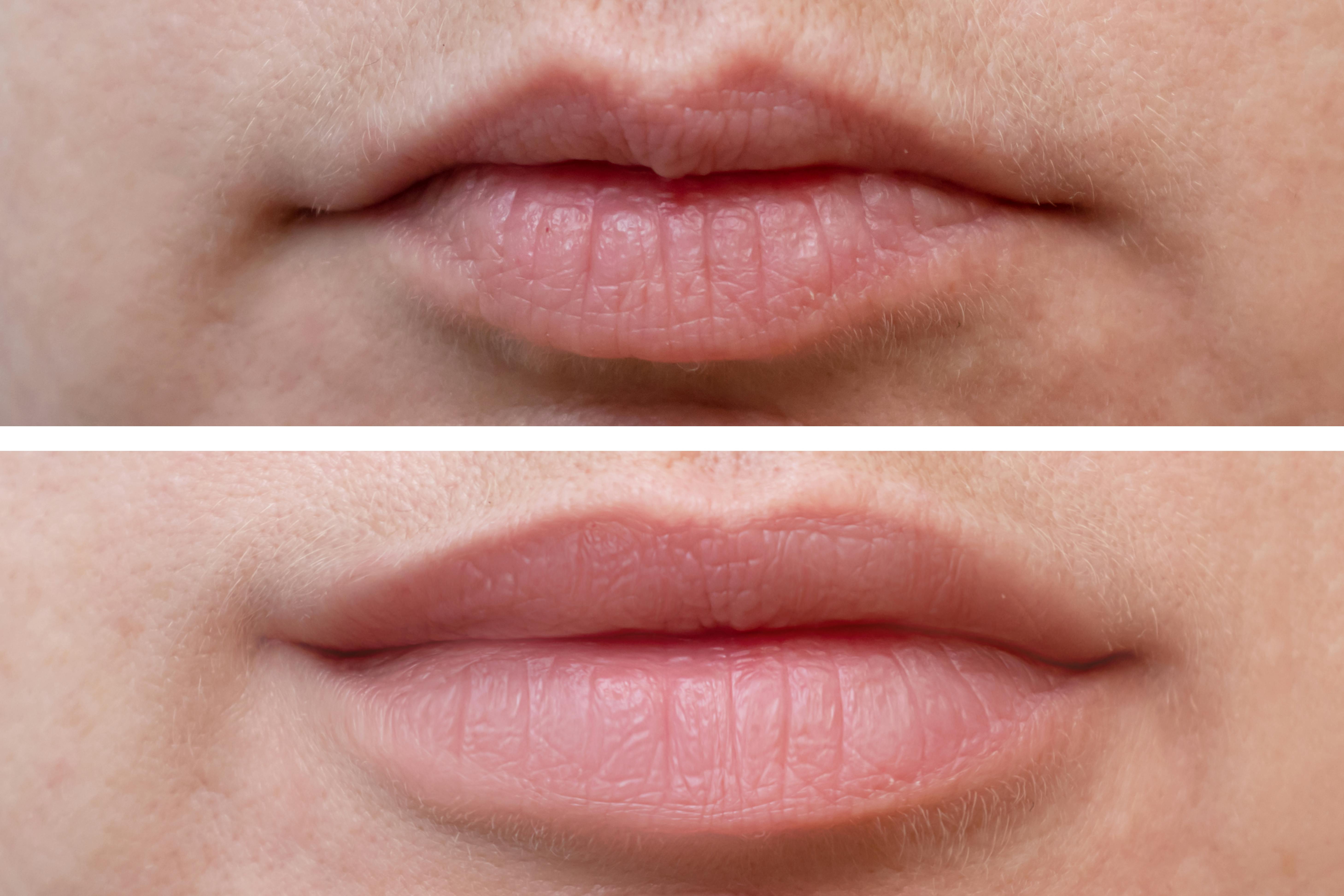 Dermal Filler Lips Before And After Lipstutorial Org