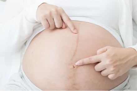 linea-nigra-causes-symptoms