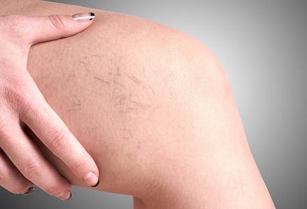 1) Varicose veins Varicose veins