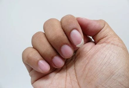 1) Brittle nails Brittle nails