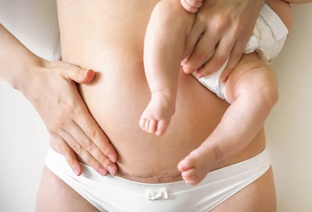 c-section-recover