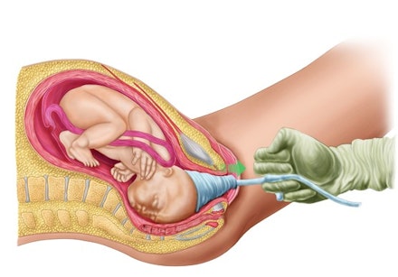 ventouse-birth_w555_h555