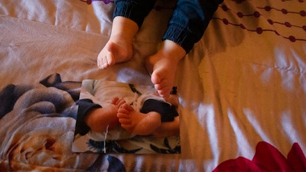 clubfoot-3