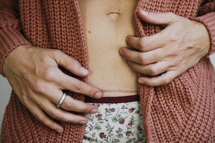 Woman showing a cesarean section scar on her belly Woman showing a cesarean section scar on her belly