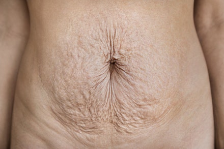 Mother's belly after childbirth stretch marks in pregnancy