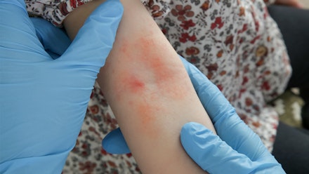 baby-eczema