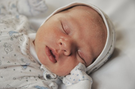 cradle cap what does it look like