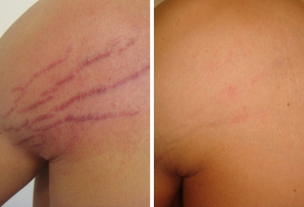 stretch mark treatment result