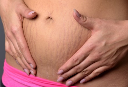stretch marks pregnancy