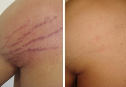 stretchmark review