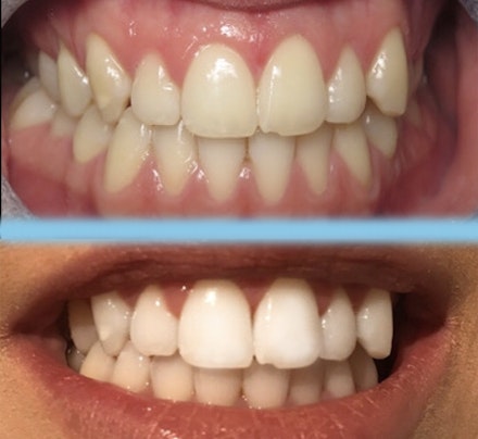 teeth whitening