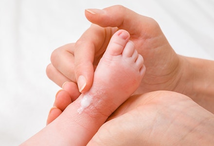 applying cream to eczema