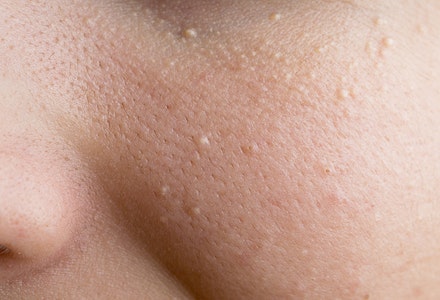 baby skin concerns milk spots
