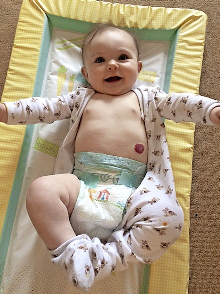 birthmark six months