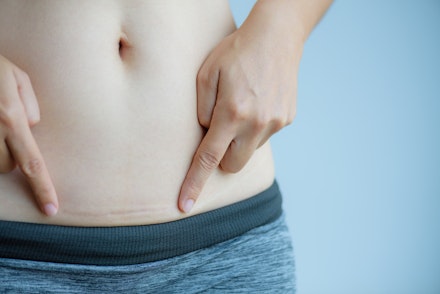 caesarean scar woman