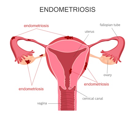 endometriosis plasmajet