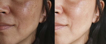 melasma how to treat