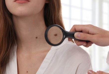 skin tags during pregnancy causes 1