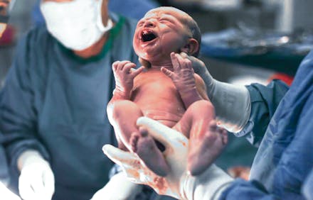 1) Most of them are twisted New born baby