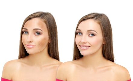 what does melasma look like