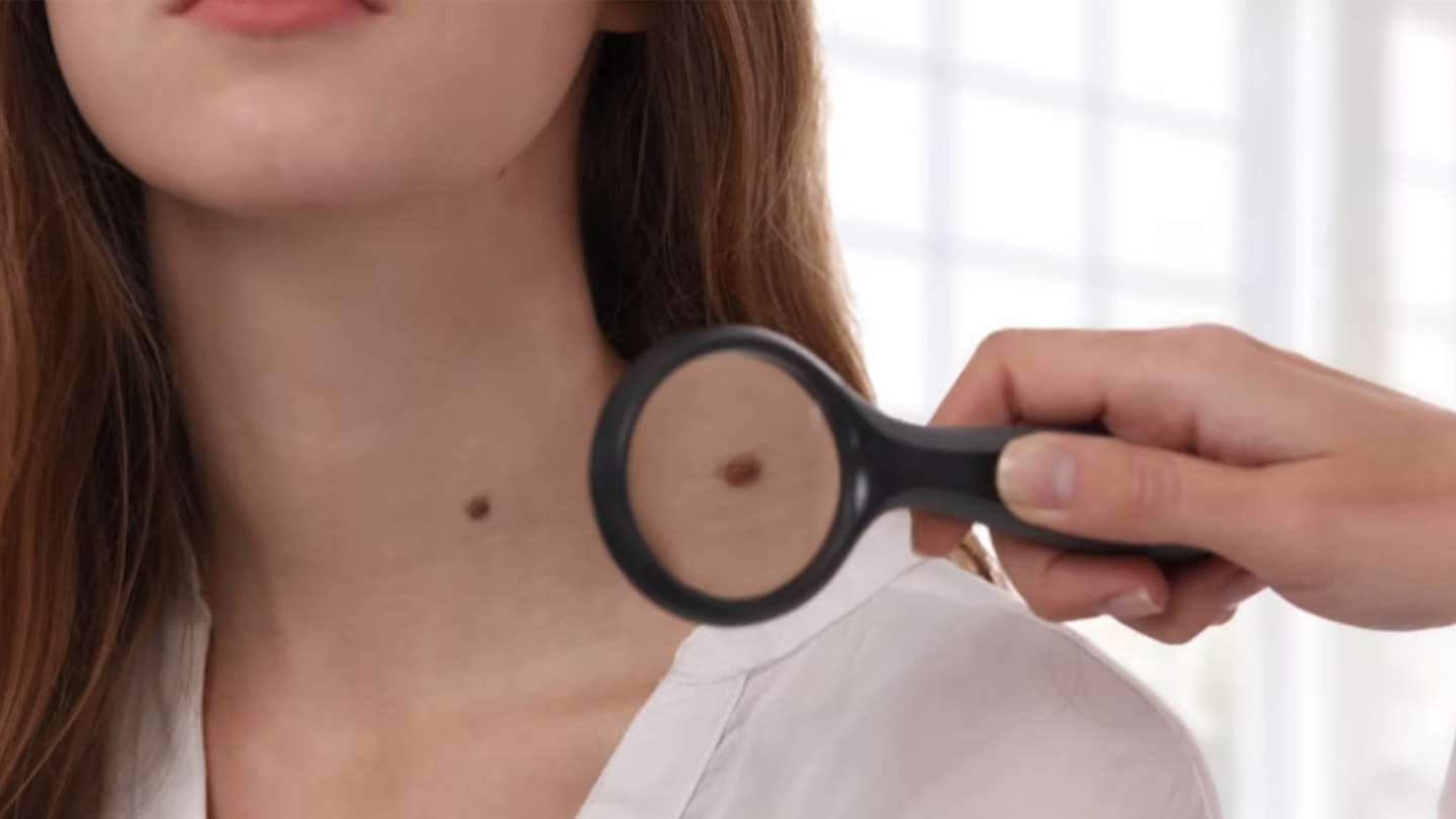 woman with skin tag