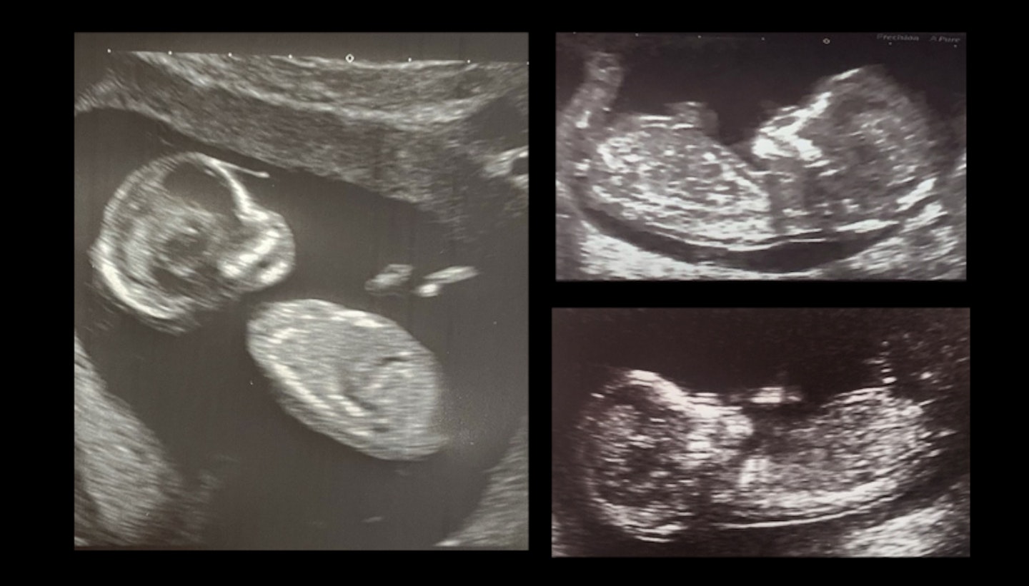 Hannah Carroll baby scan photos Skull theory