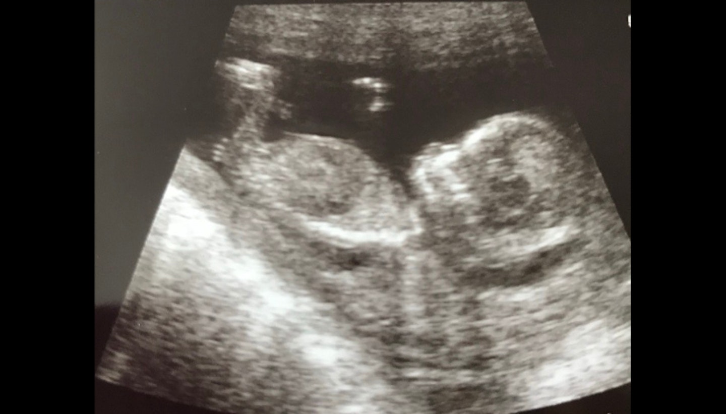 Laura Healy baby scan