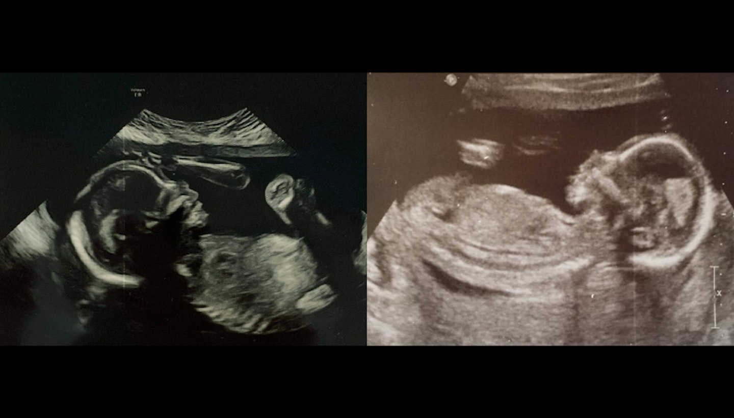 Samantha Ball baby scan images