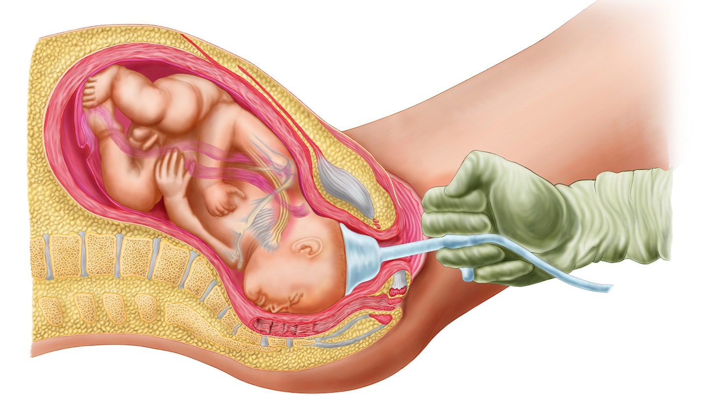 shoulder dystocia birth