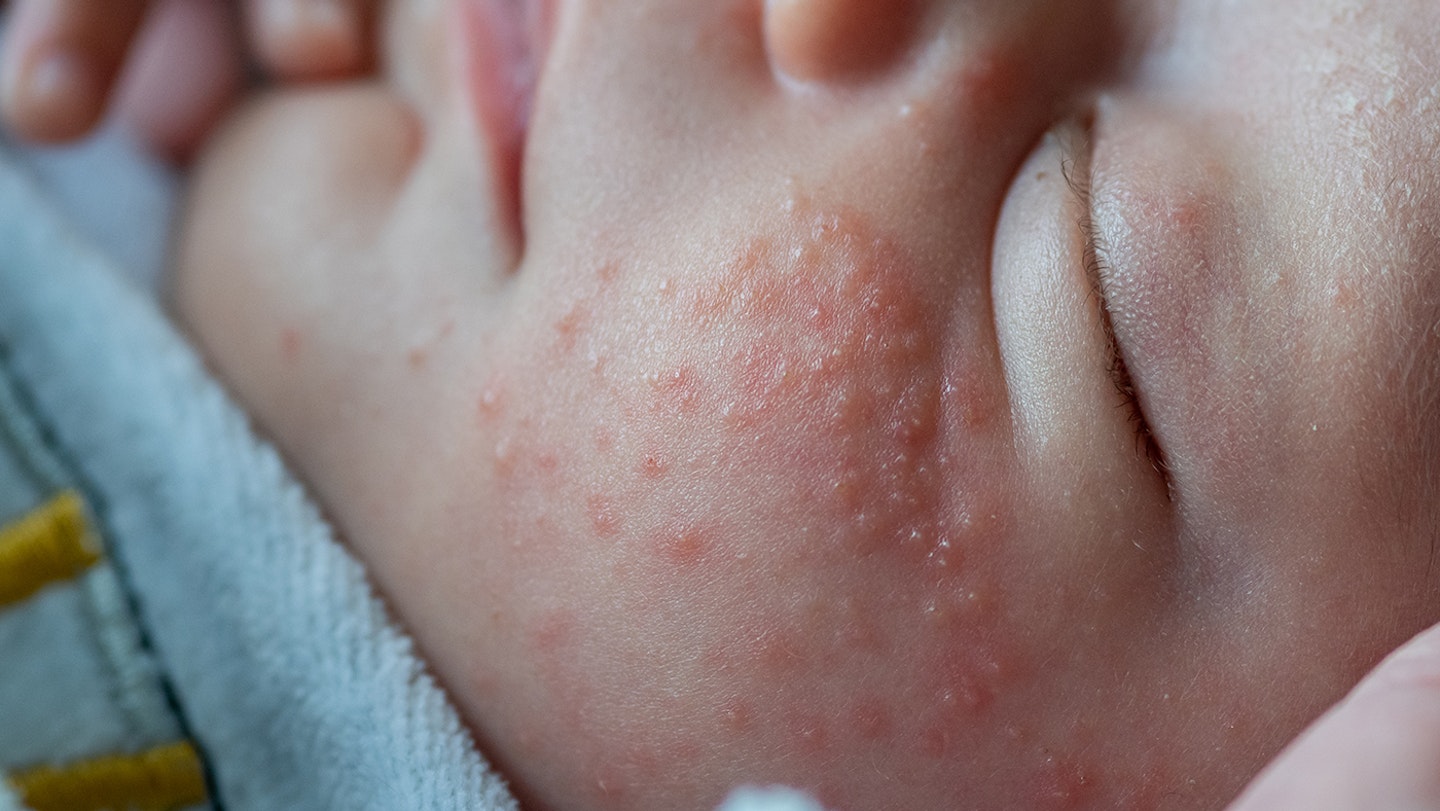 Close up of baby milk spots or Milia on baby's cheek