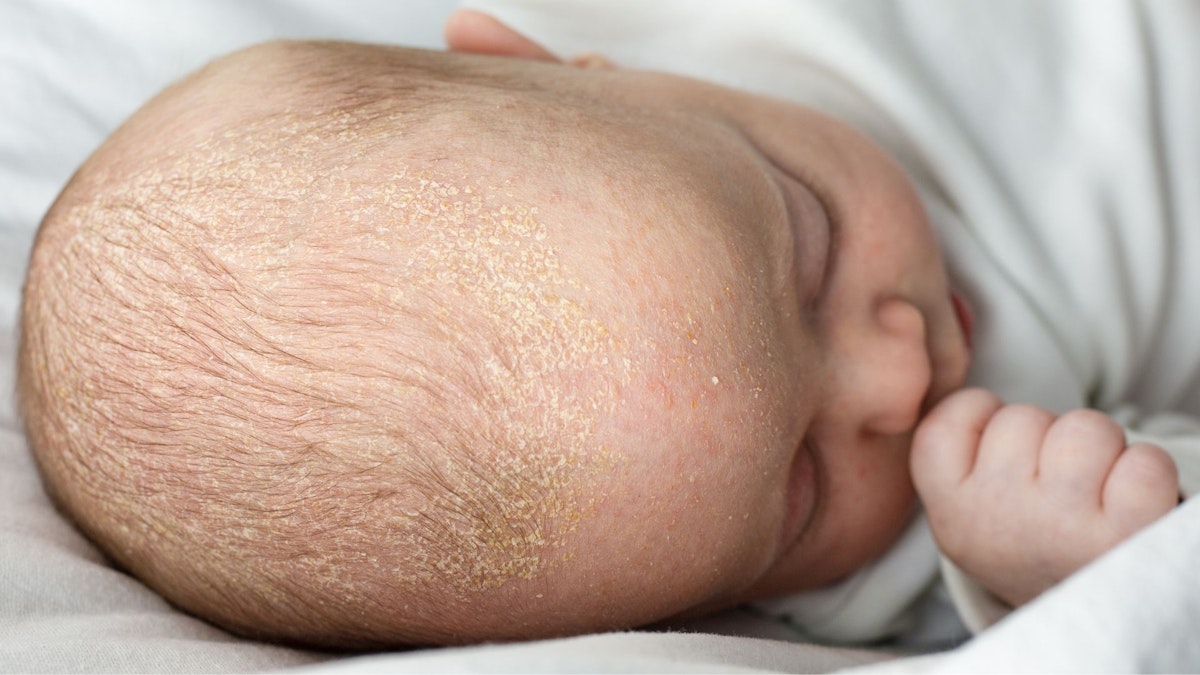 Cradle cap what causes it and how is it treated?