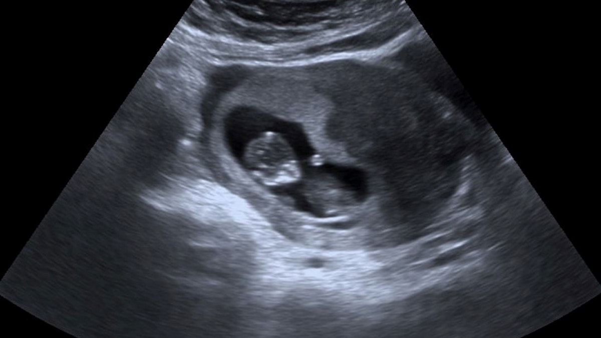 Ten weeks pregnant: ultrasound, symptoms and development