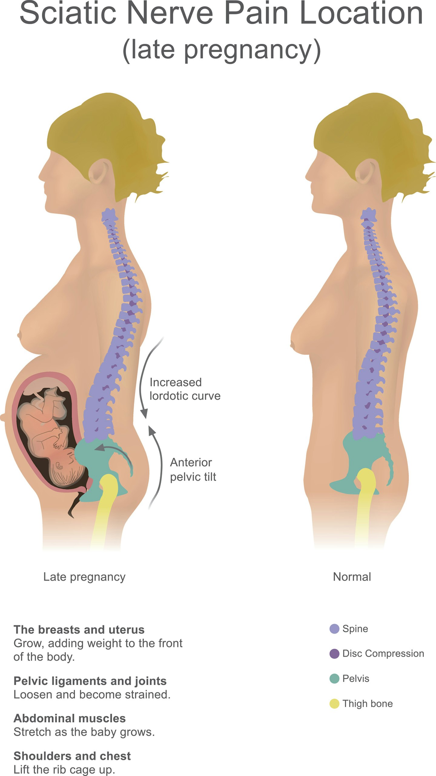 Sciatica in pregnancy
