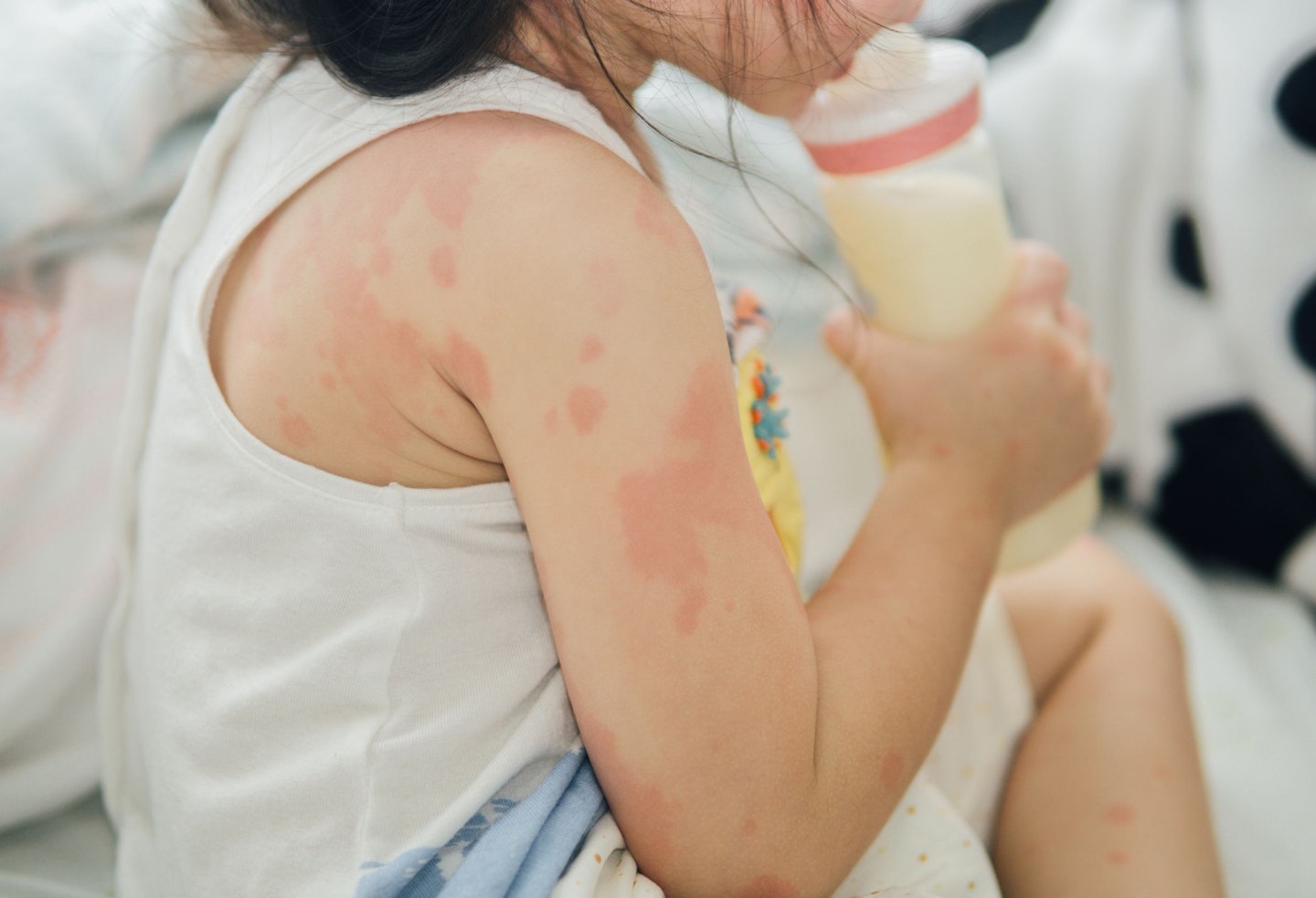 Child with Skin Allergy