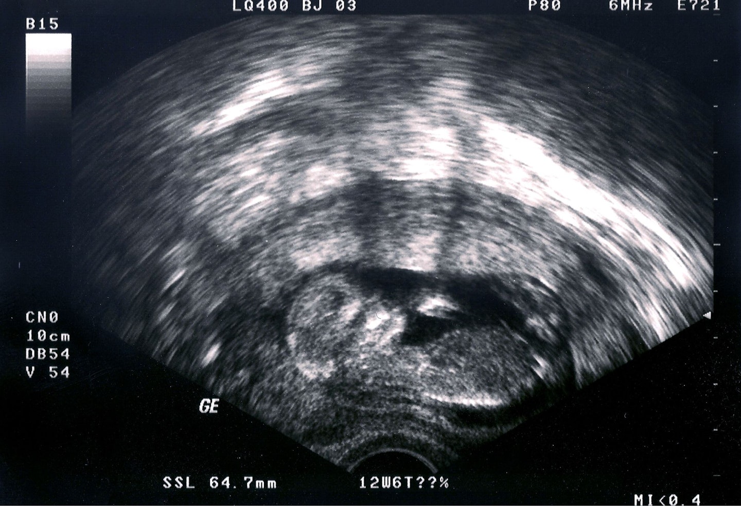 Ultrasound of a fetus, 12 weeks