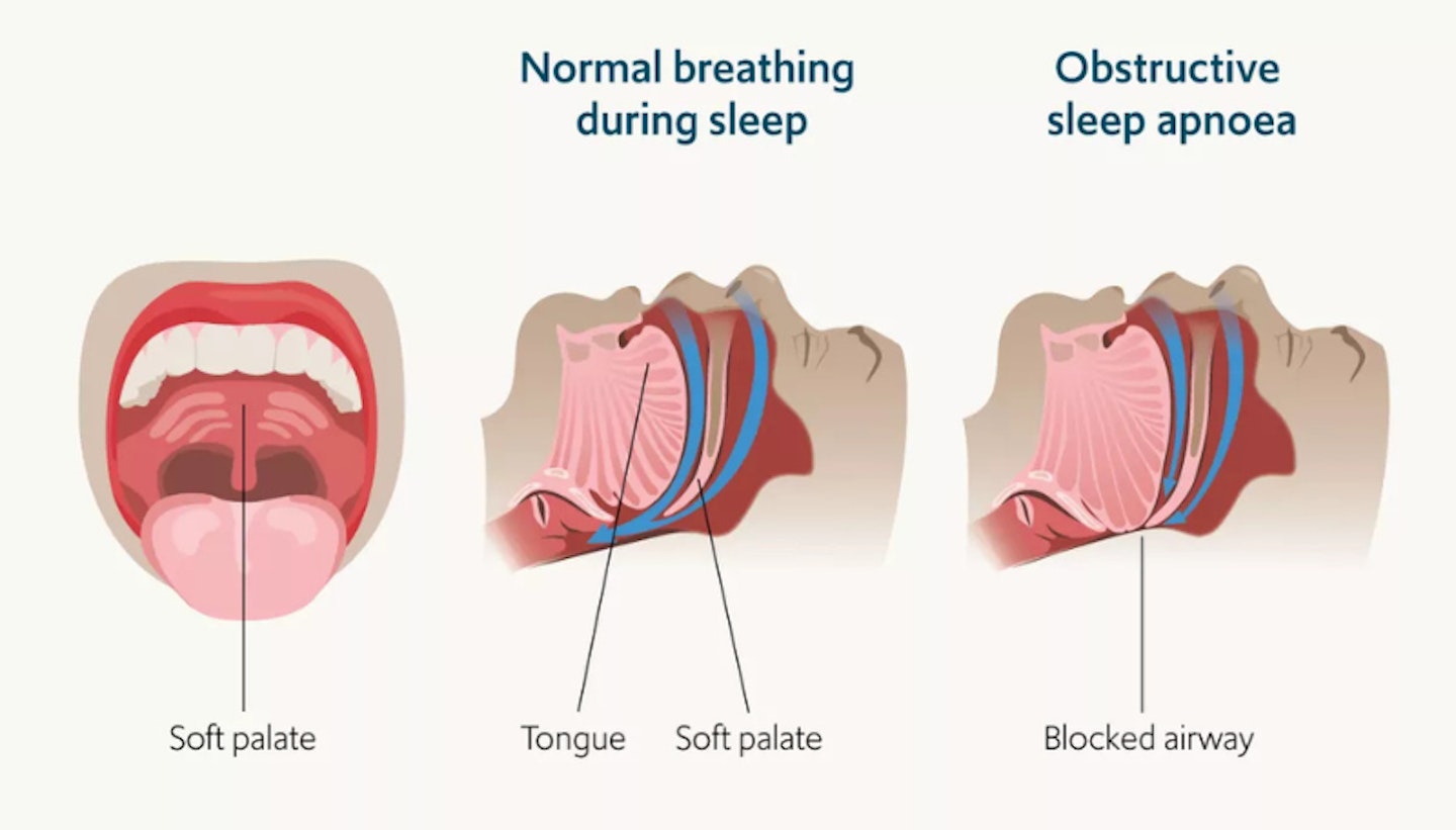 diagram showing blocked airways for kids sleep apnea