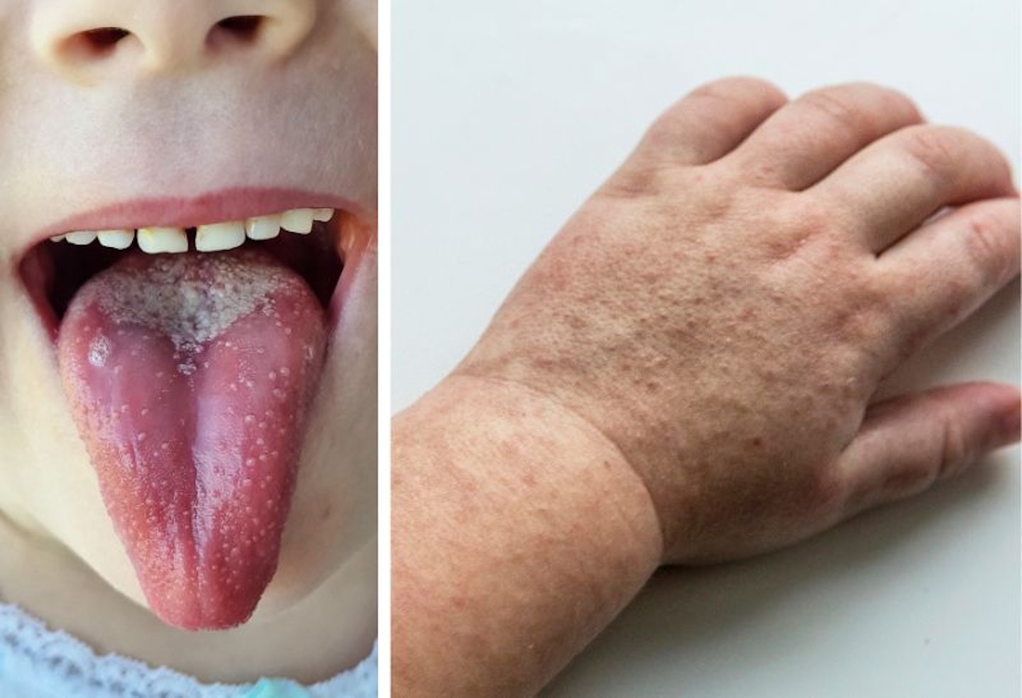 Scarlet fever symptoms