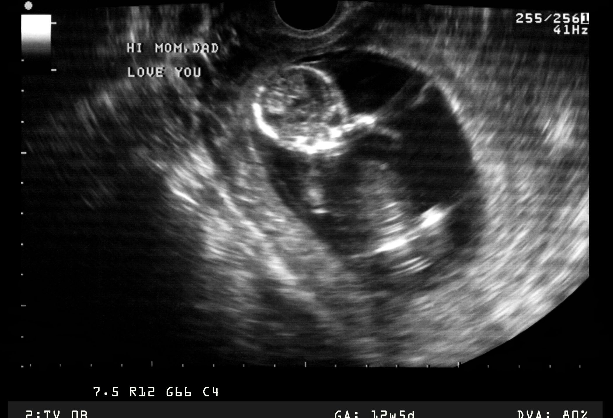 Sonogram image of 12 week old fetus