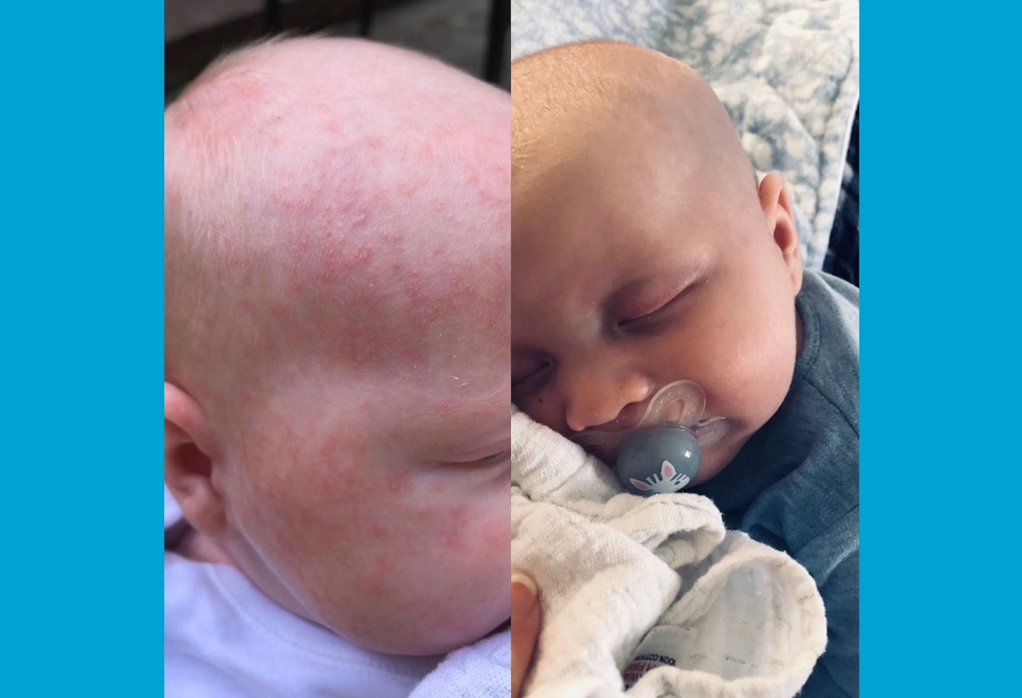 Image of baby before and after using the best baby moisturiser