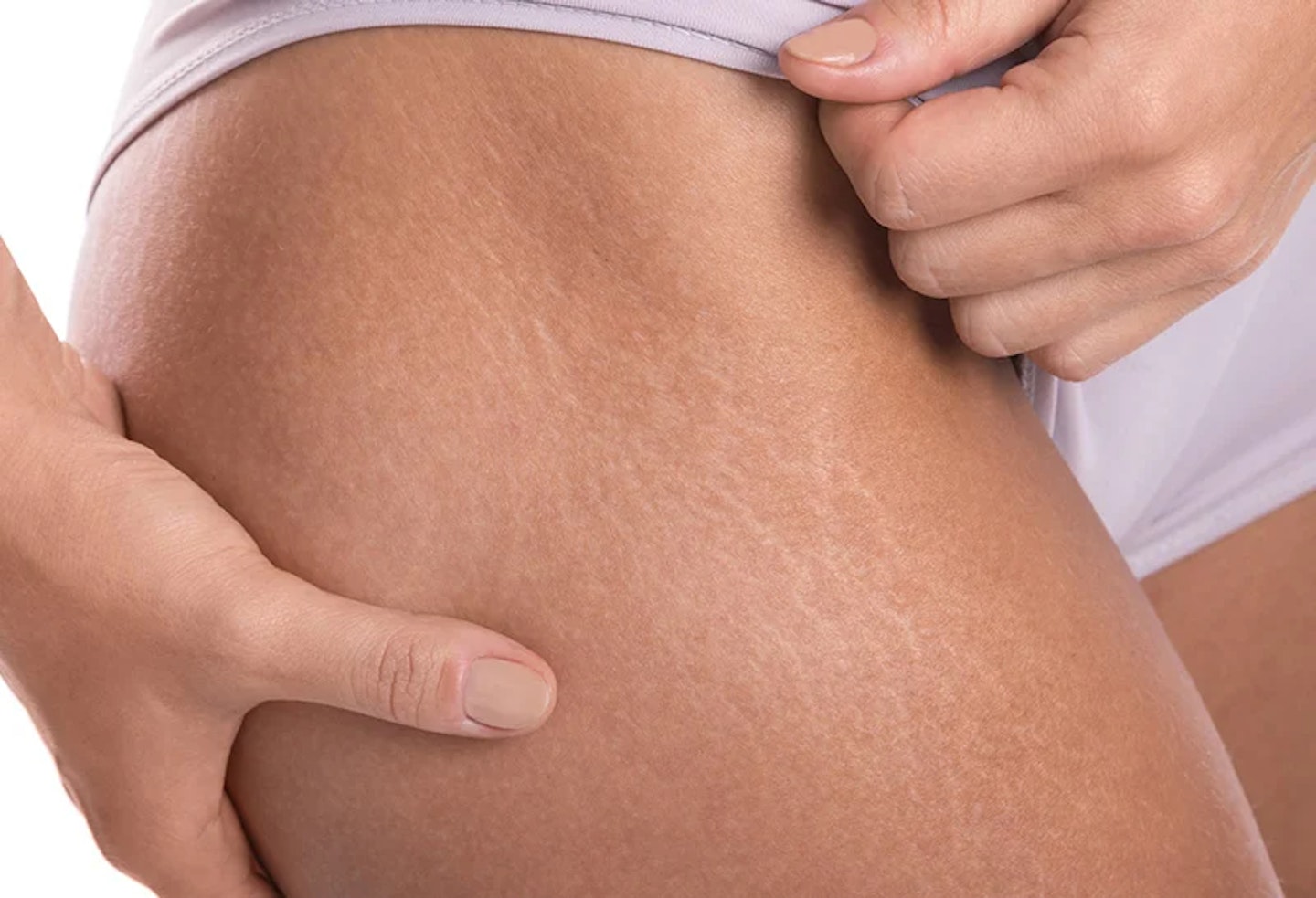 22-weeks-pregnant-symptoms-stretch-marks
