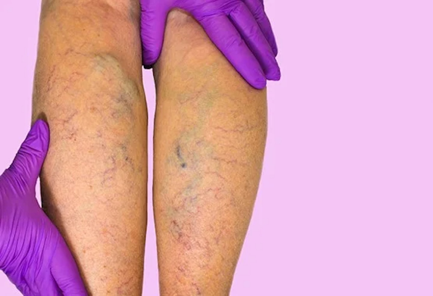 Varicose veins