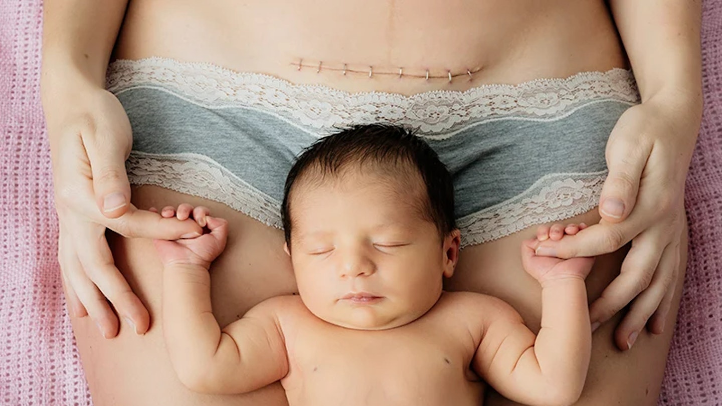 c-section scar and baby