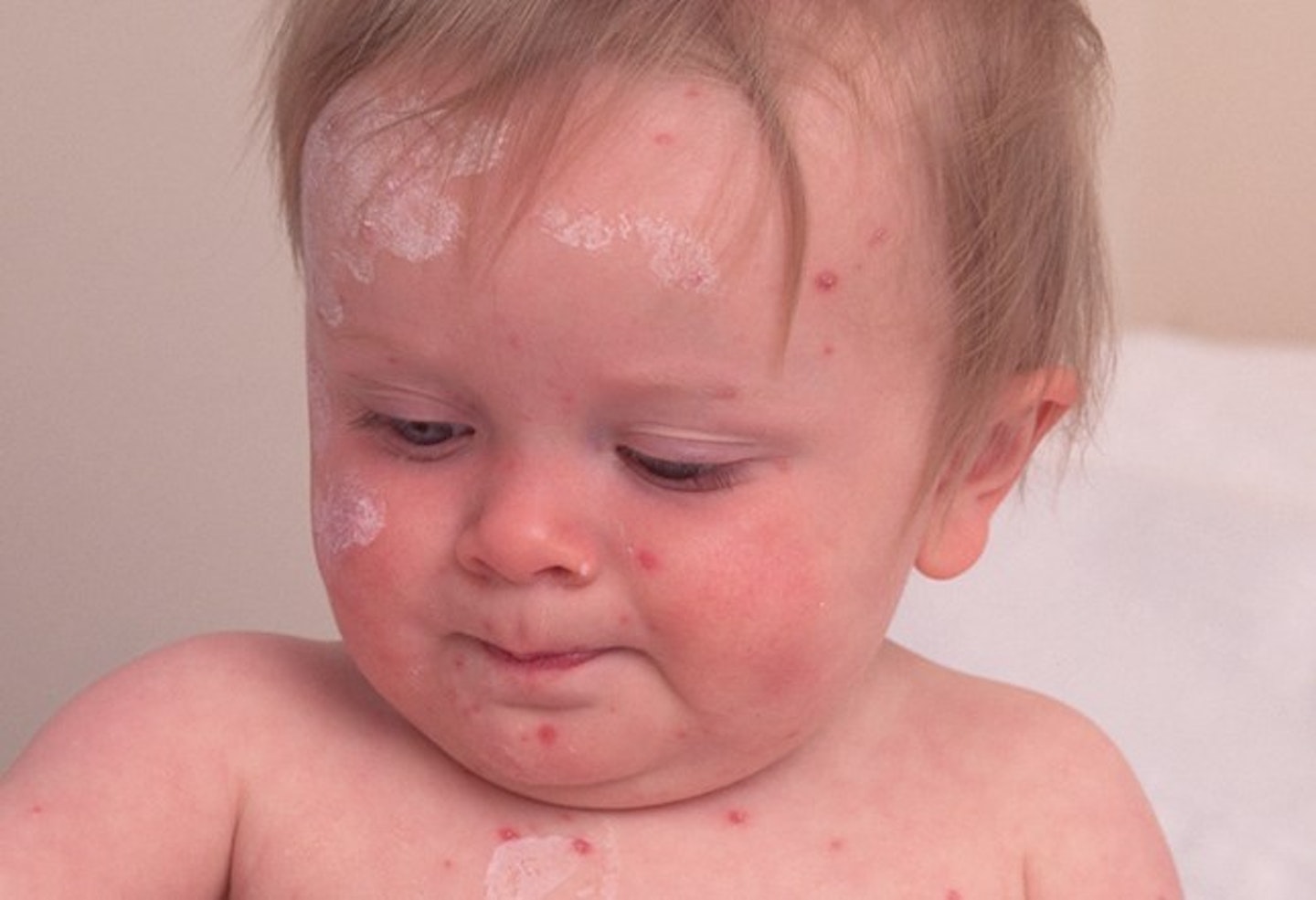 Chicken pox