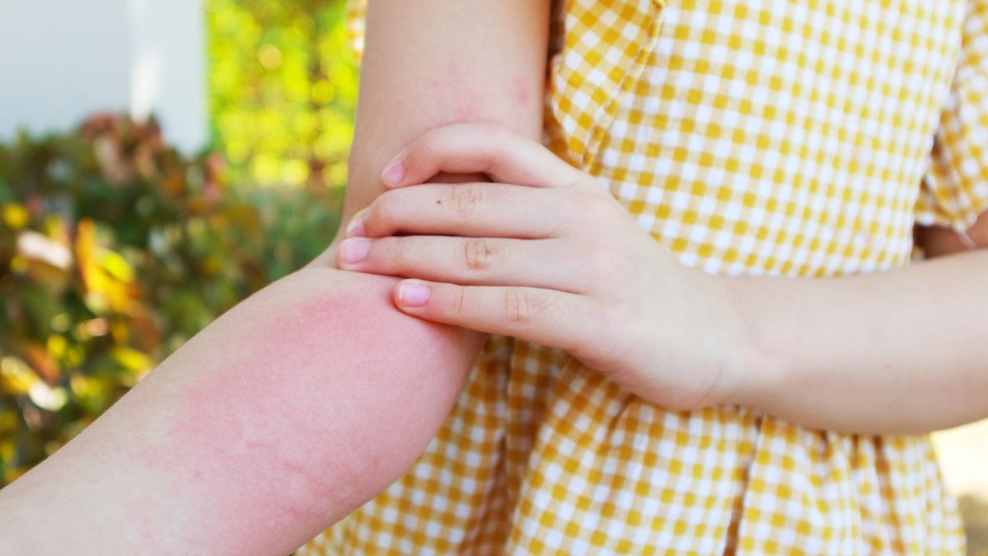 sunscreen for kids with eczema