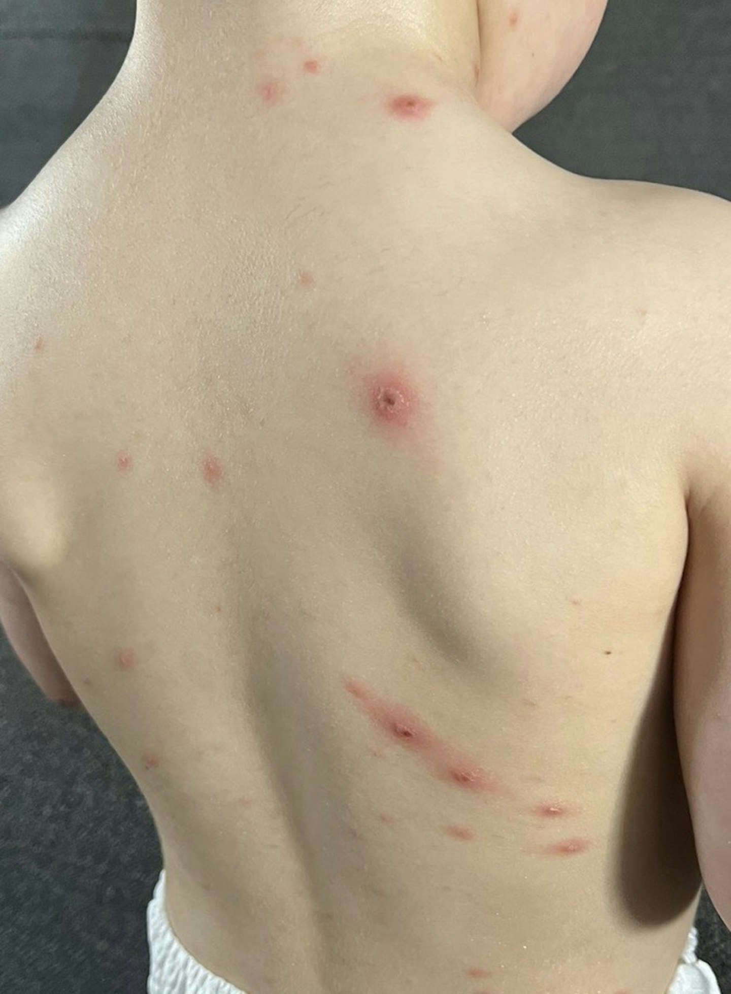 My son's chickenpox