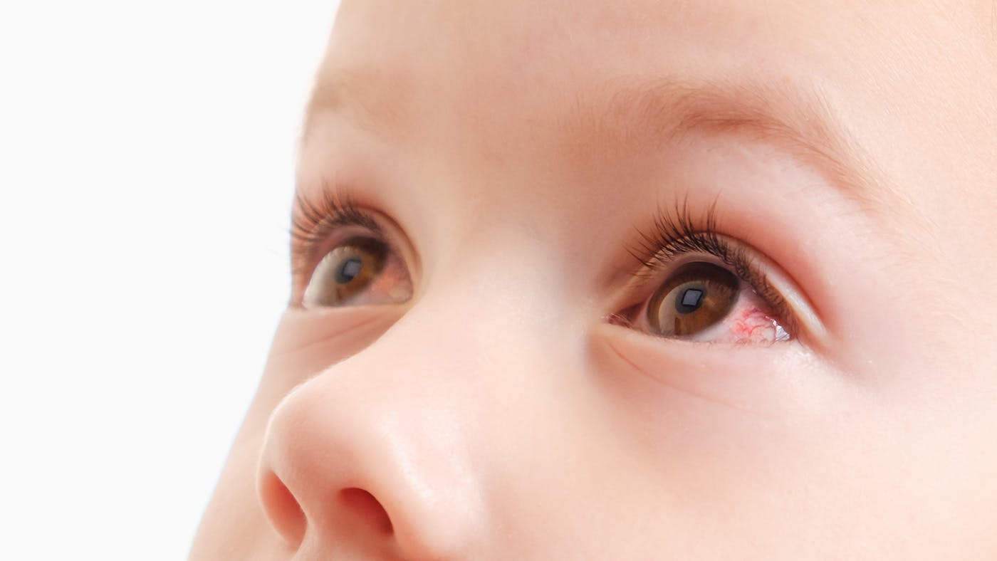 Conjunctivitis in toddlers causes and treatment