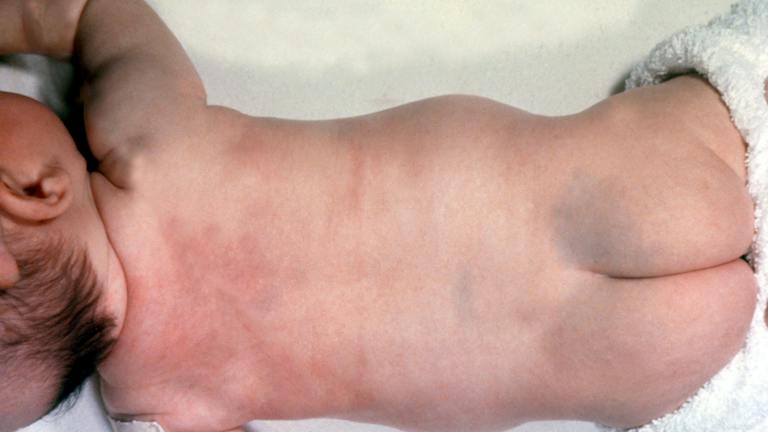 Blue grey Birthmarks Congenital Dermal Melanocytosis Blue grey Birthmarks Congenital Dermal Melanocytosis