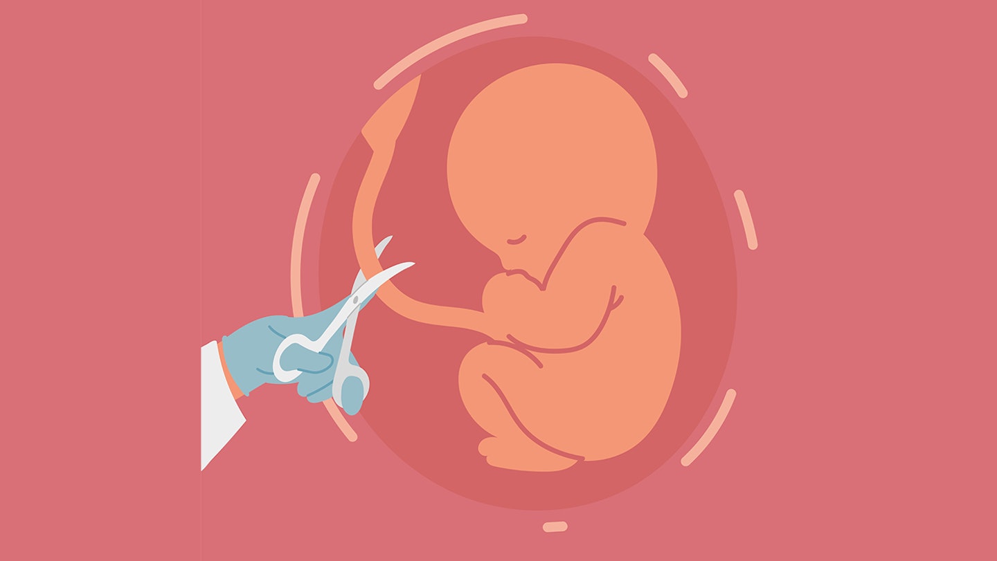 illustration of a baby having umbilical cord cut